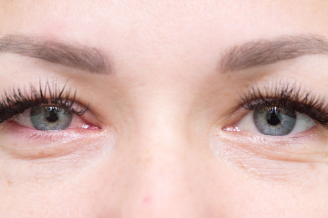 What Is Pink Eye Caused By?